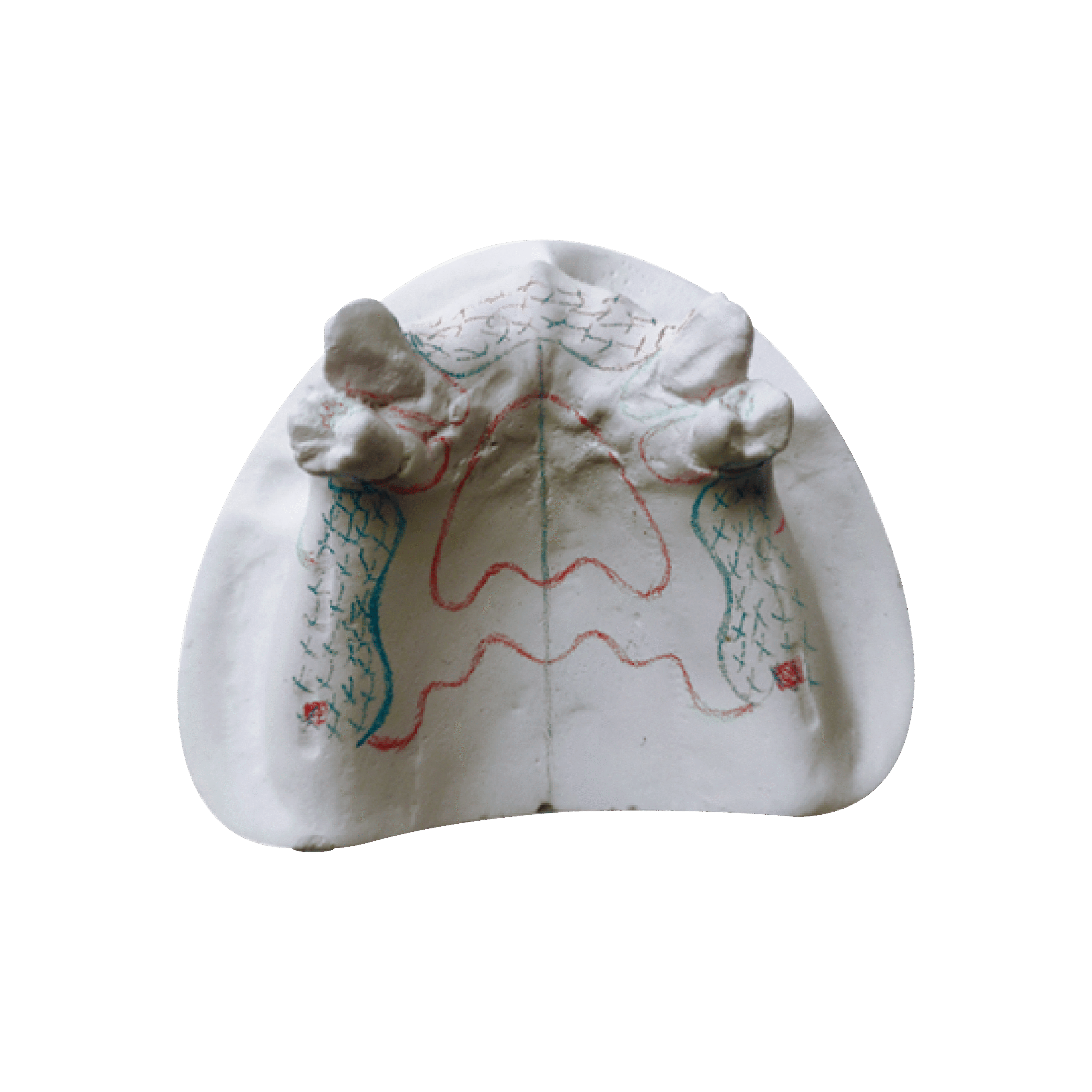 iPDenture RPD
